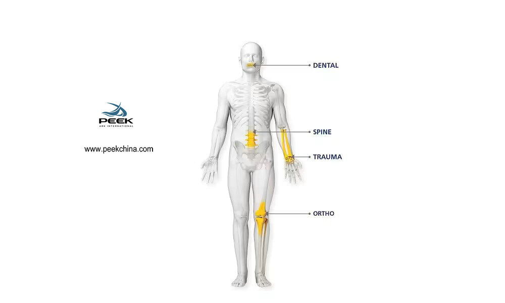 Application of PEEK Material in the Medical Device Industry