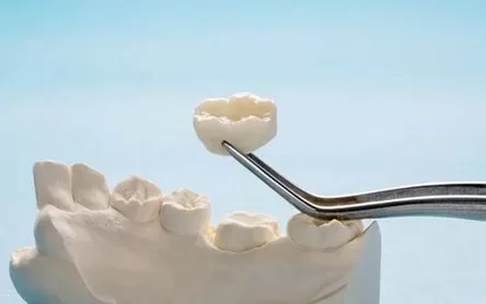 PEEK in Dental Implants: Biocompatibility and Aesthetic Benefits